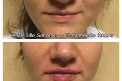 Filler labbra con acido ialuronico 3