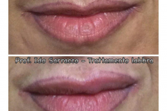 Filler labbra con acido ialuronico 7