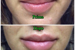 Filler labbra con acido ialuronico 1