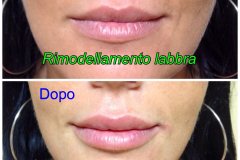 Filler labbra con acido ialuronico 2