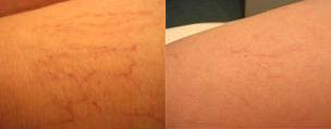 Trattamento laser dei capillari delle gambe - prima e dopo