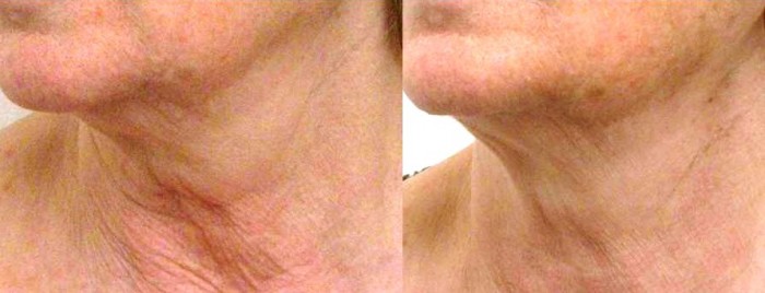Radiofrequenza per rilassamento pelle del collo, prima e dopo