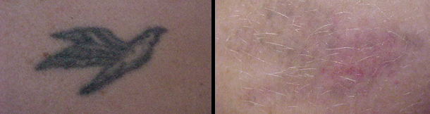 laser tattoo prima e dopo 2