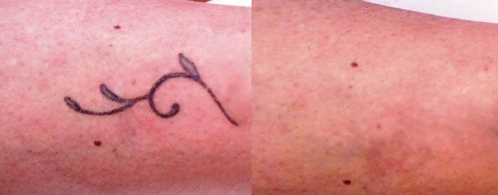 laser tattoo prima e dopo